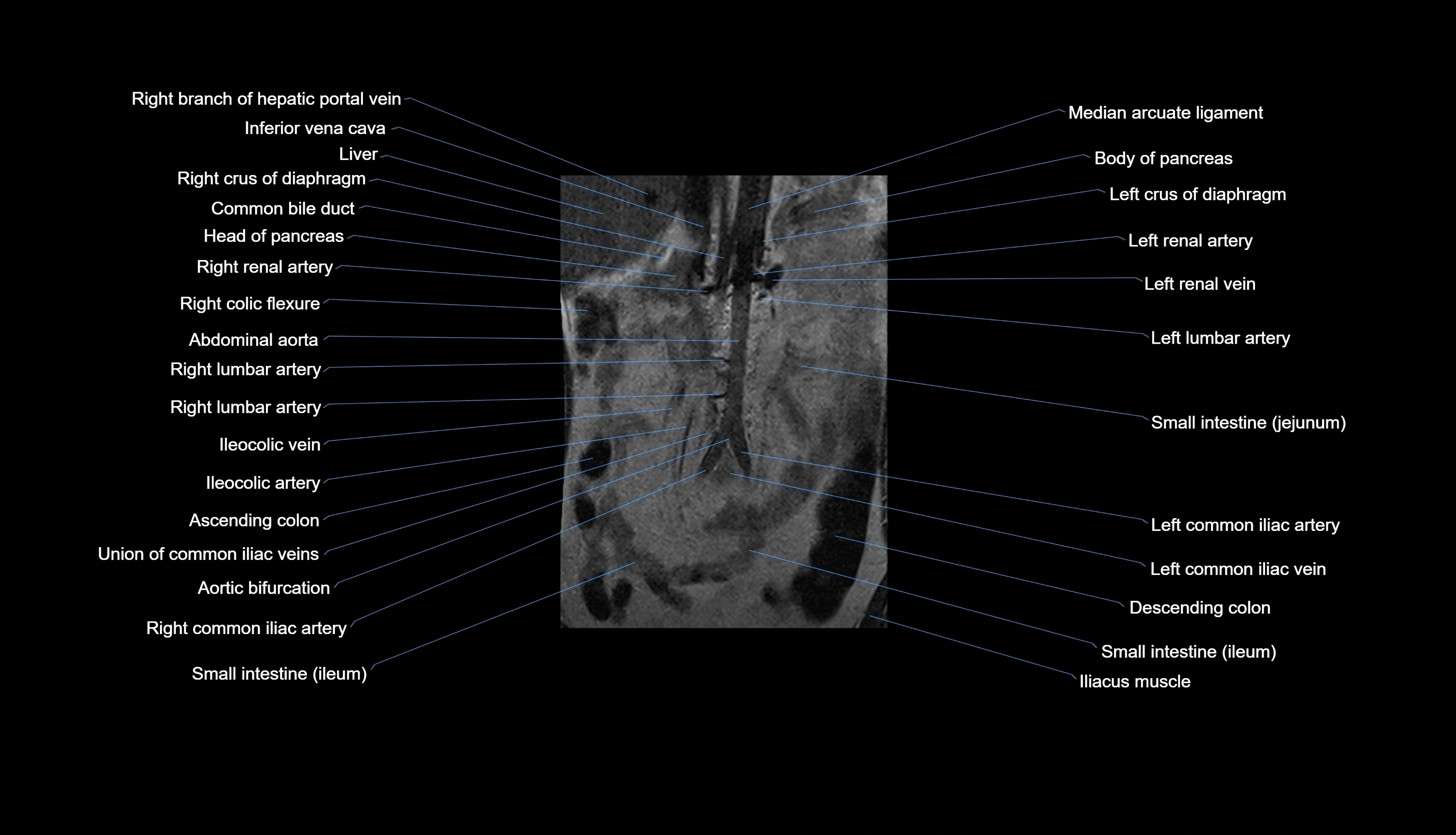MRI lumbar spine labelled coronal cross sectional anatomy 3T radiology-img-00001-00002.webp